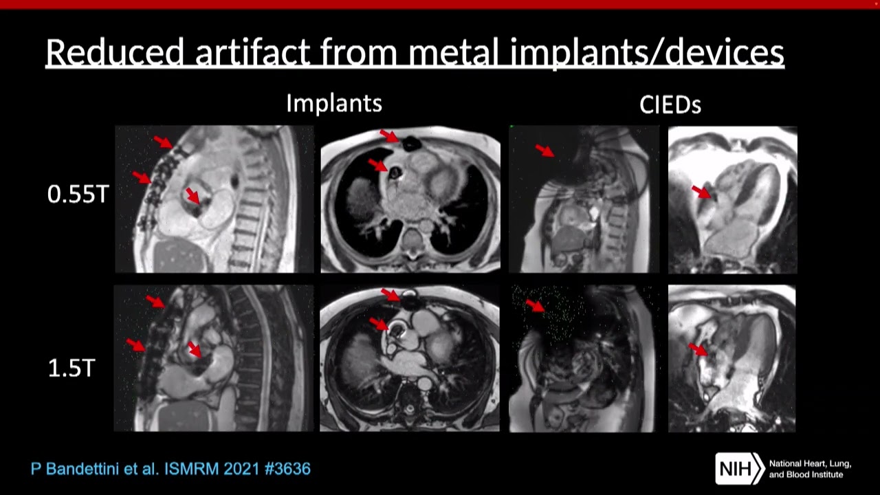 Plenary Session II 5 Low Field Cardiovascular MR – Presented by Krishna Nayak