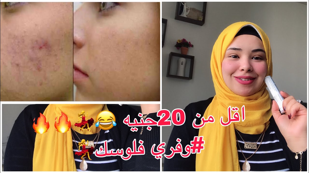 ودعي اثاااار حب الشباب للأبد بكريمات اقل من 20جنيه 🔥💃