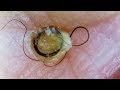 【閲覧注意】鼻の角栓（黒ずみ）をオリーブオイルで除去！オロナインパックやワセリンよりいいと話題！！綿棒でにゅるにゅる取れる！【引くくらい取れる】