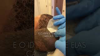 Retorno Transplante capilar após 1 semana! #cuidadocomcabelo #transplantecabelo