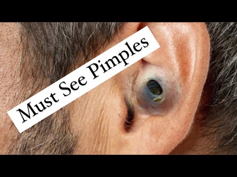 Large Ruptured Pilar Cy$t Removal Documentary & Case Study