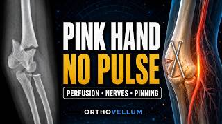 Supracondylar Humerus Fractures — Perfusion, Nerves, Pinning