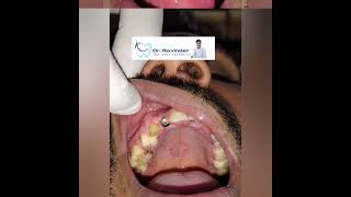 IMMEDIATE DENTALIMPLANT IN ESTHETIC ZONE #trending #cosmeticdentist #delhidentist #smilemakeover