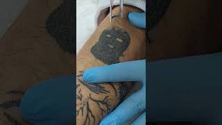 Dövme Silme İşlem Videosu 1