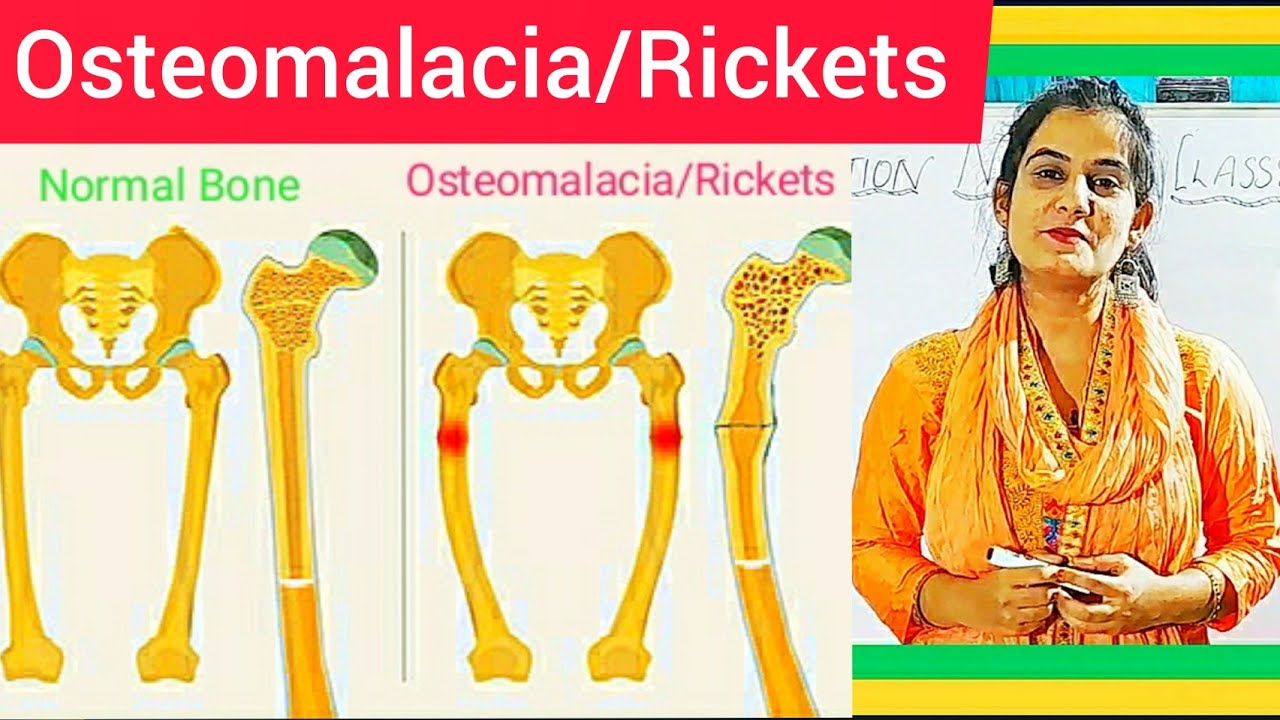 Osteomalacia And Rickets Cause Symptom Treatment Diagnosis Medical