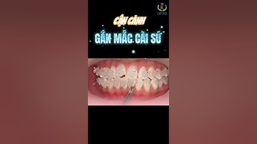 Quy trình gắn mắc cài sứ || Dr.Trịnh Đức Mậu || Nha Khoa Quốc Tế Việt Đức