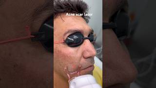 Acne Scar Laser Before And After