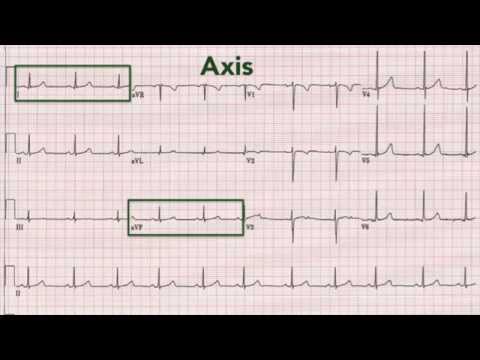 ecg-interpretation:-recognising-normal