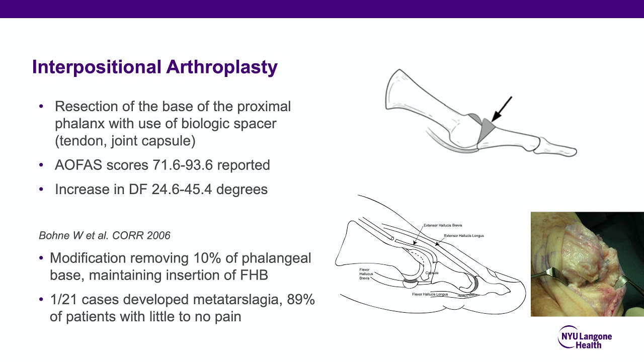Hallux Rigidus ABOS Orthopedic Surgery Board Exam Review YouTube