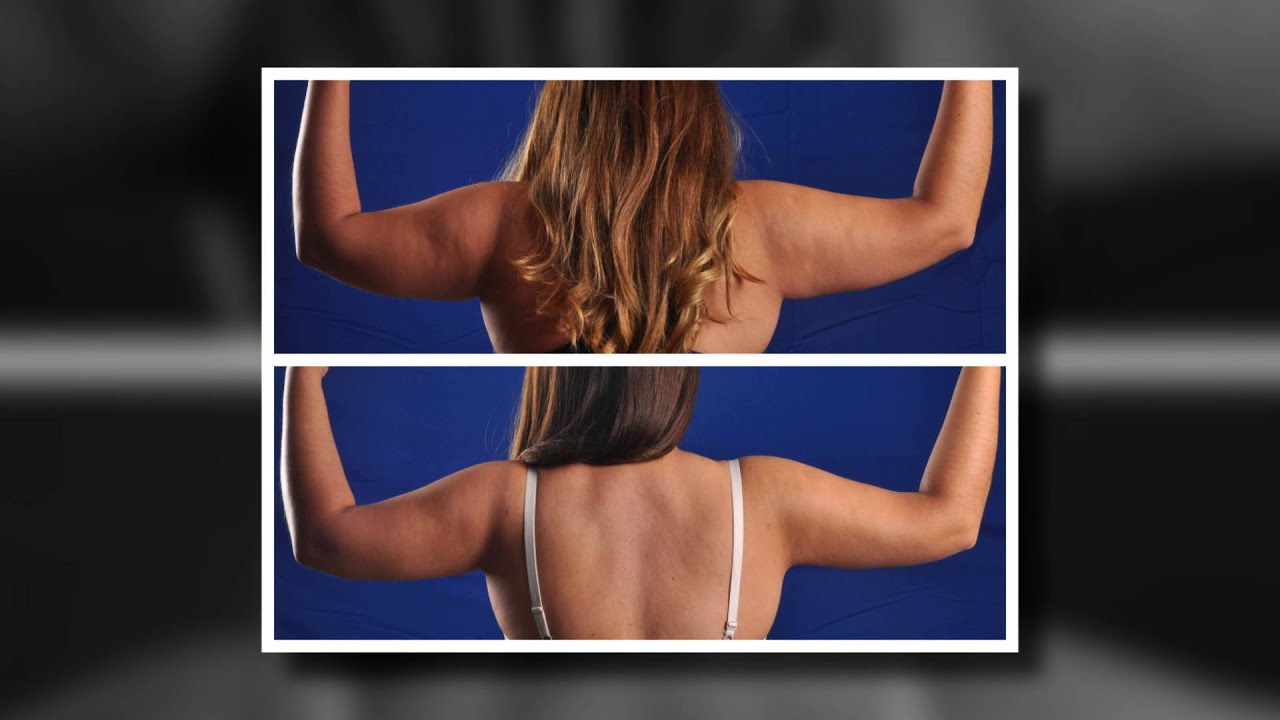 Phoenix Liposuction Results Arms YouTube