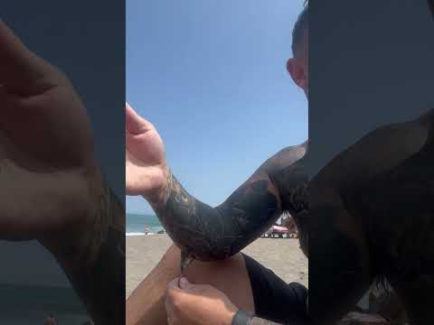 Guy goes surfing before a recent injury is healed and has skin dangling from his arm!