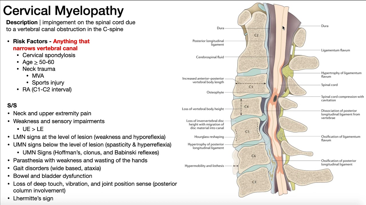 Cervical Myelopathy Presentation Risk Factors Signs Symptoms