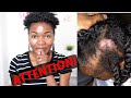 MUST WATCH ! TINEA CAPITIS - INFECTION OF THE SCALP - SOLUTIONS & CAUSES! NATURAL HAIR JOURNEY