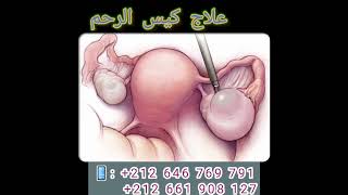 علاج الكرة وكيس الرحم