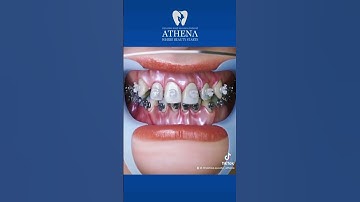 Gắn mắc cài sứ và mắc cài kim loại như nào? #nhakhoa #dentist #dentalbraces