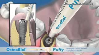 Osteobiol putty