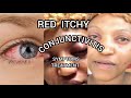 Conjunctivitis  how to get rid of itchy eyes  red eyes  eye infection  polo just in one week