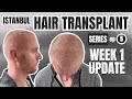1 Week After My Hair Transplant in Istanbul (Recovery Update)
