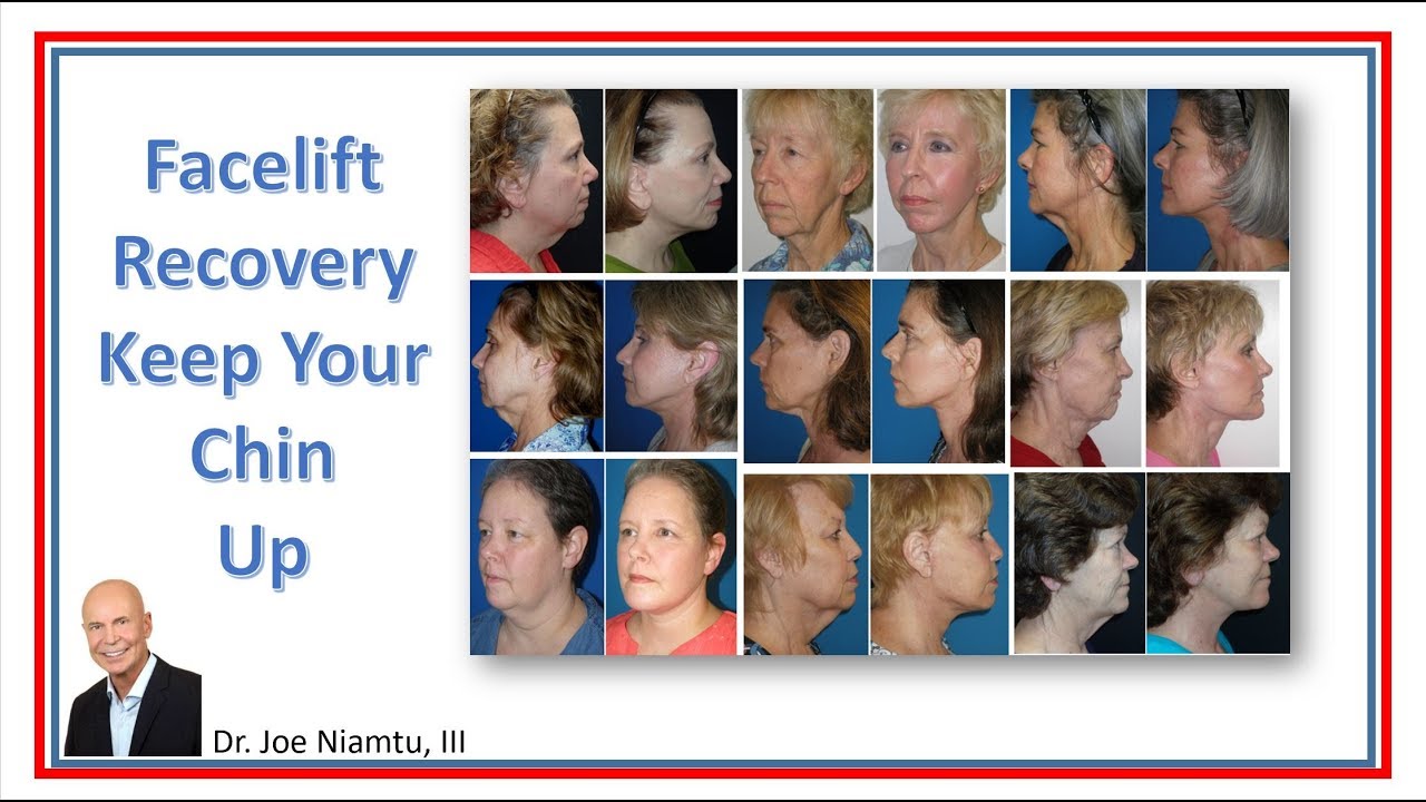 Facelift Recovery Keep Your Chin Up! YouTube
