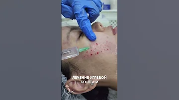 Лечение угревой болезни