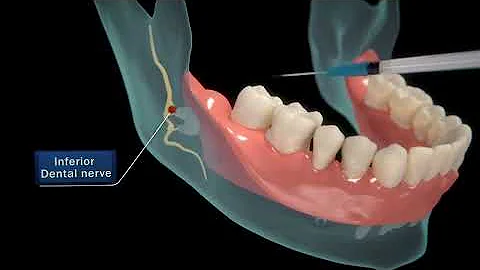 Wisdom Teeth Extraction - Step by step