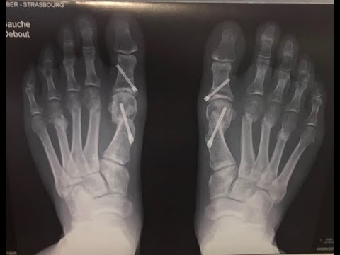 ATLET BULUTANGKIS OPERASI HALLUX VALGUS BUNION DI PERANCIS (Mes résultats Opération Hallux Valgus)