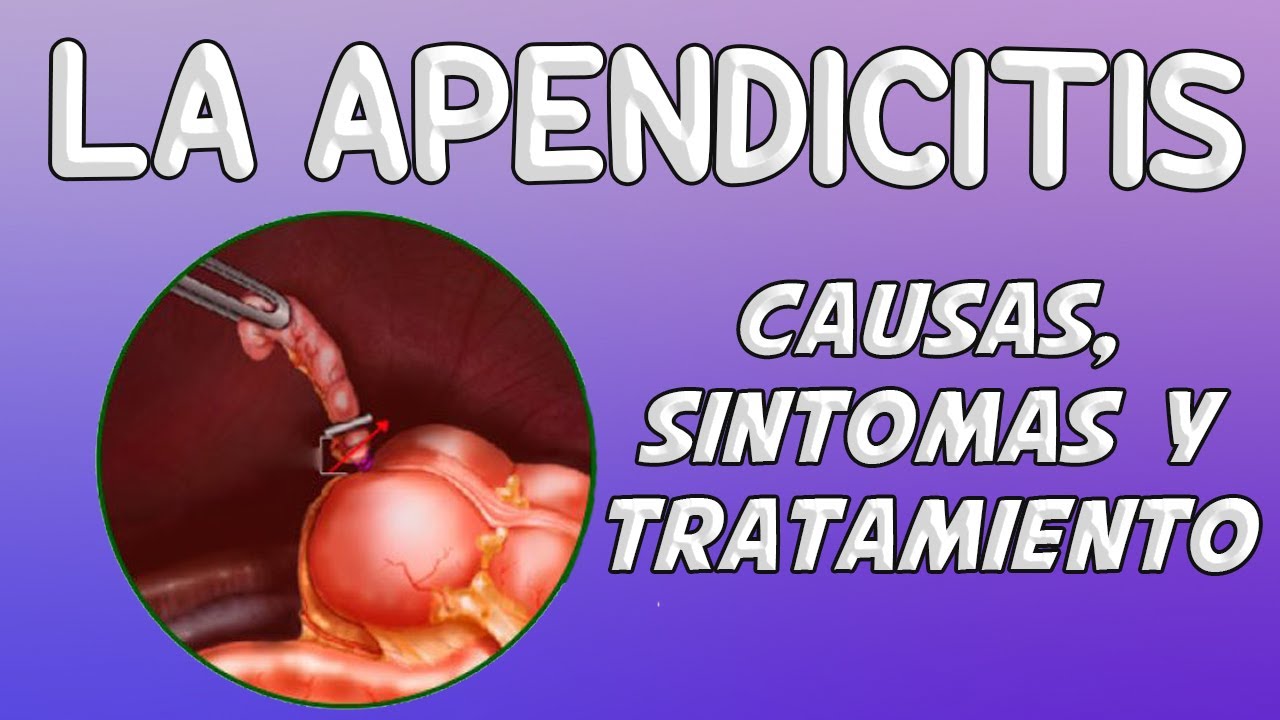 Donde esta el apendicitis en las mujeres