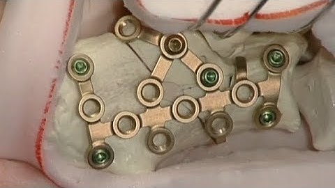 Calcaneus - Intraarticular Fracture - Fixation Using the Calcaneal Locking Plate