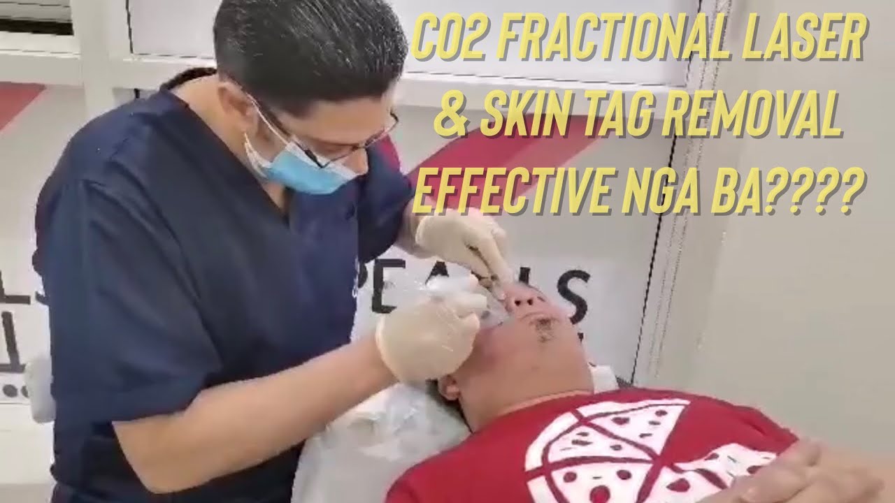 Fractional CO2 Laser • Tas Clinic