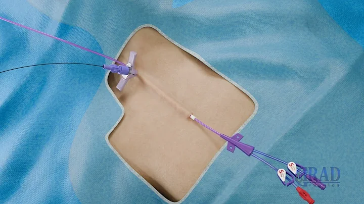 Tunneled Venous Infusion Catheter (Long-term Central Venous Access) Placement