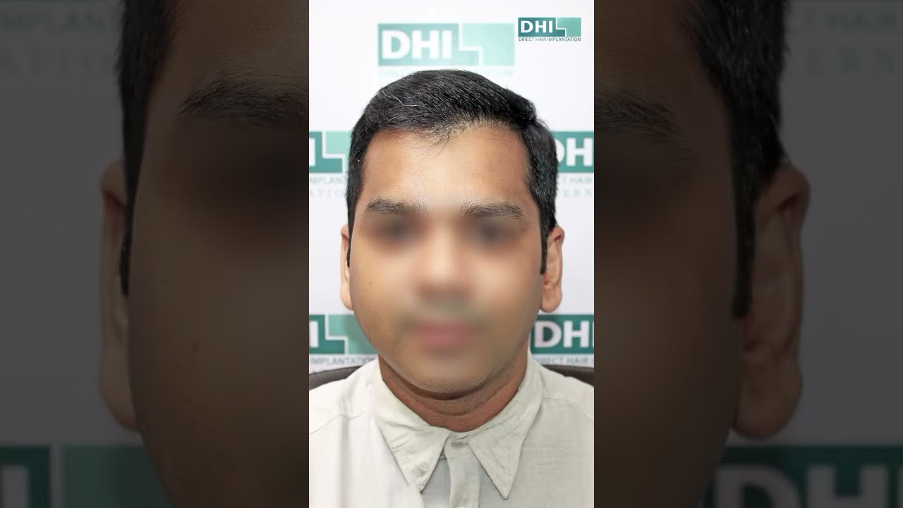 From Bald to Bold: Life Transformed with a DHI™ Hair Transplant