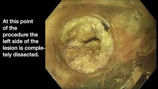 Circumferential Rectal-Anal ESD for recurrent adenoma.