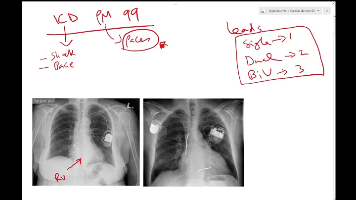 Pacemaker or ICD 99 for medical students and residents - Dr Jamal usmle - cardiology lecture