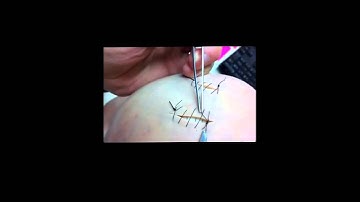 Removing a Running Suture - Final