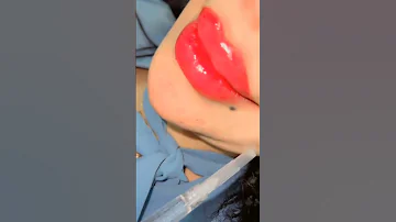 حقن الفيلر الشفايف مجمع النور الطبي 