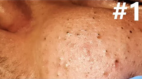 BIG BLACKHEADS EXTRACTIONS on Happy :) - #1