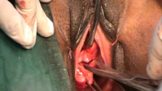 Opening of anterior and posterior pouch in case of Non-Descend