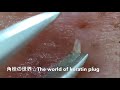 【No.18】角栓連続抜き!I try to take the keratin plug.