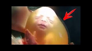 When the doctors did a C-section and saw the baby, they couldn't believe their eyes! by Life Stories 12,621 views 1 year ago 4 minutes, 12 seconds