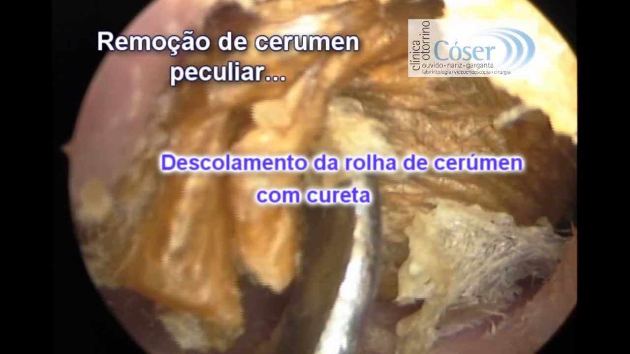 The Biggest Earwax removal by otoendoscopic technique ever??-A Maior cera de ouvido do mundo??