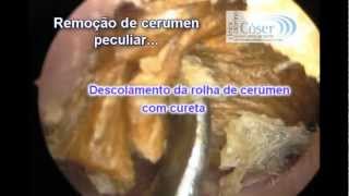 The Biggest Earwax removal by otoendoscopic technique ever??-A Maior cera de ouvido do mundo??