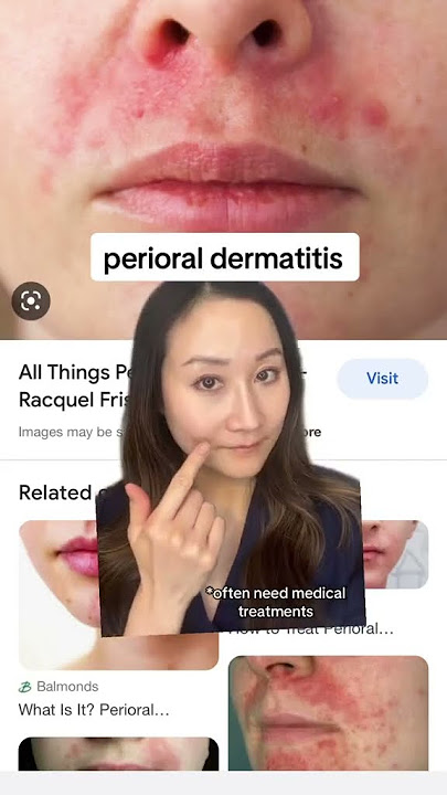 If you have rosacea & skin redness watch this