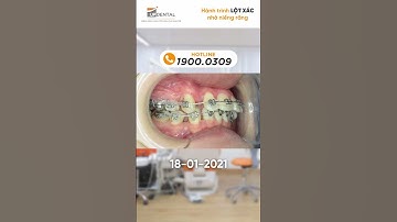 Hành trình LỘT XÁC nhờ niềng răng của khách hàng Kim Ngân