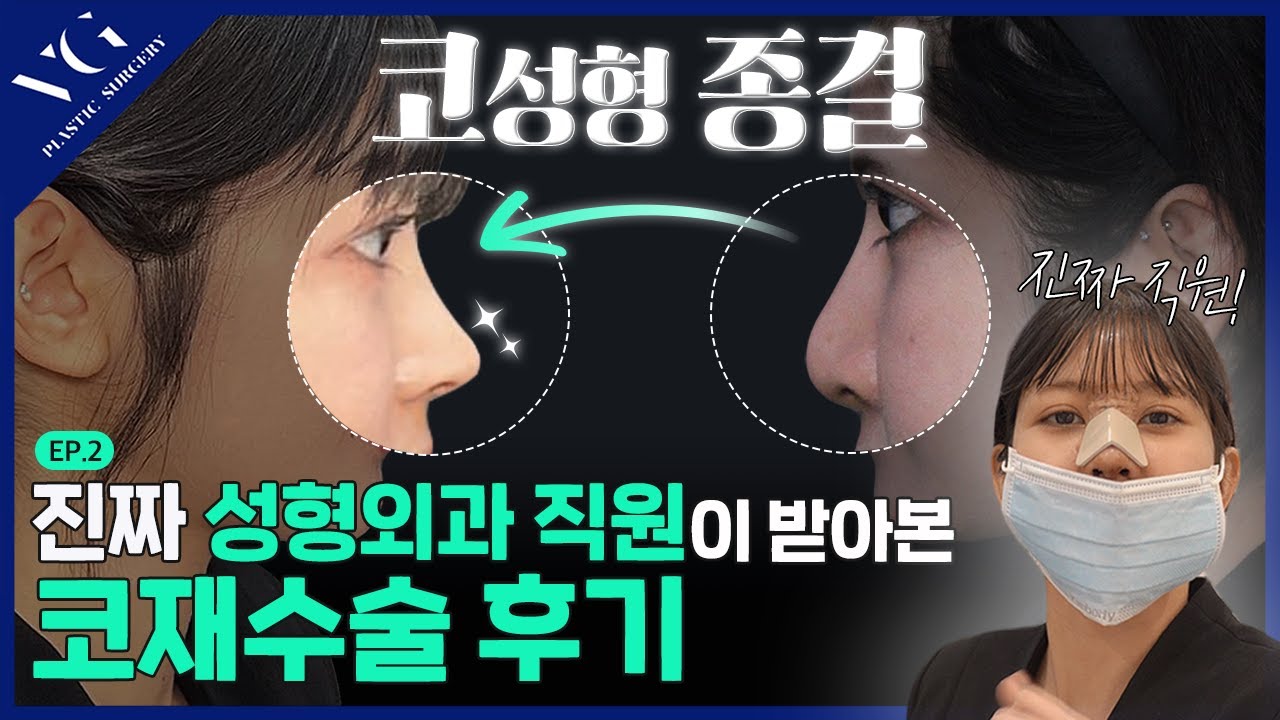 [貝瑞好整形外科診所] 隆鼻修復手術後變成溫特的故事揭秘✨ | 整形外科員工親身體驗的隆鼻手術。EP2