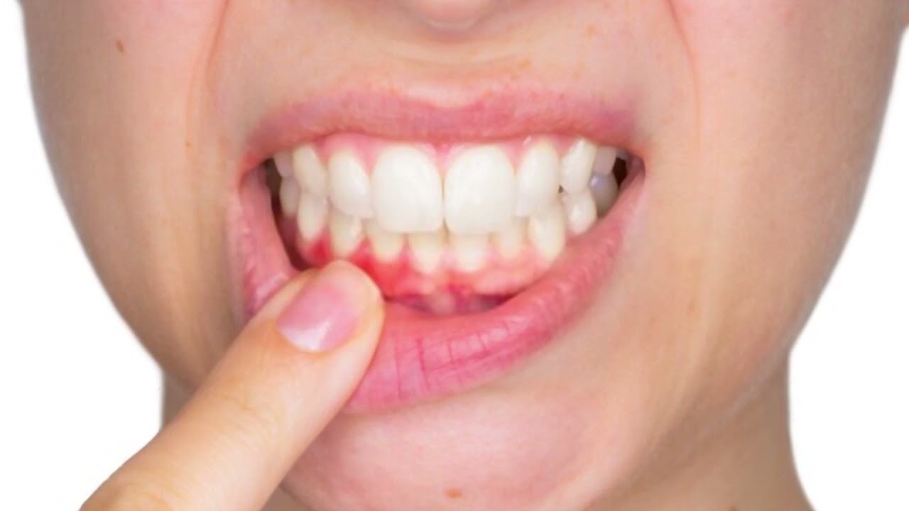 Deep cleaning for Retainers and Dentures! Safe and Gentle | Persulfate free!