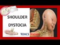 Shoulder dystocia  toacs and osce station