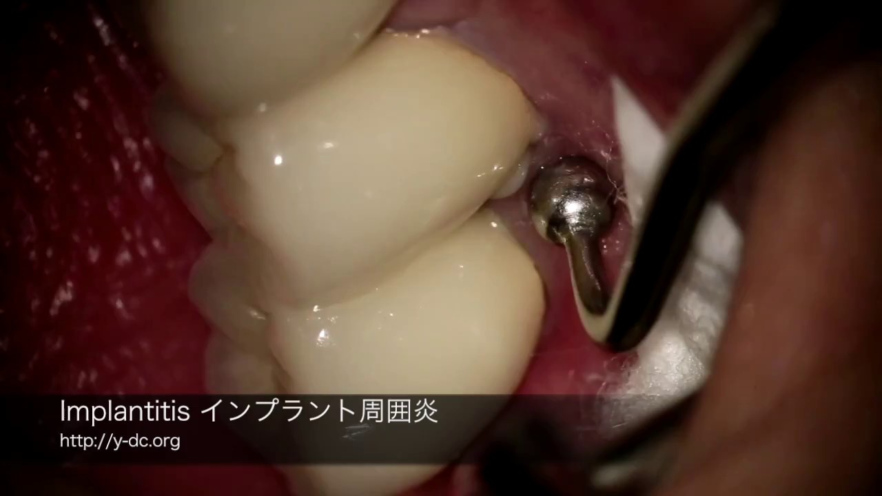 インプラント周囲炎はどう見えるのか