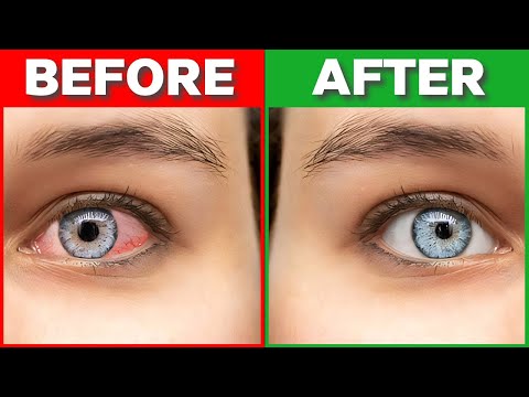 How To Get Rid Of Pink Eye | Best Tips