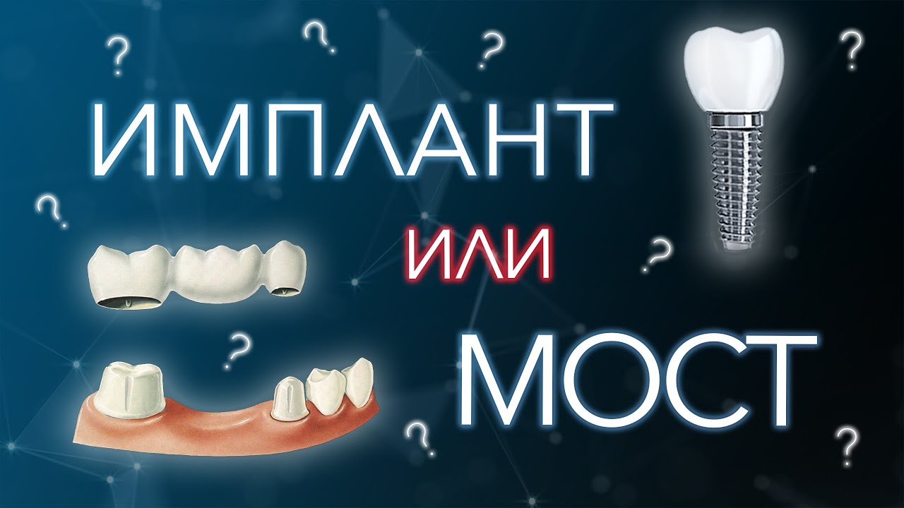 Зубной имплант или мостовидный протез. Что выбрать. - YouTube