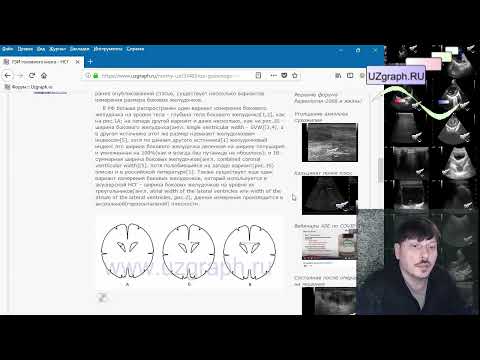 Аудио-статья: Нормы УЗИ - УЗИ головного мозга - Нейросонография - НСГ - у детей норма